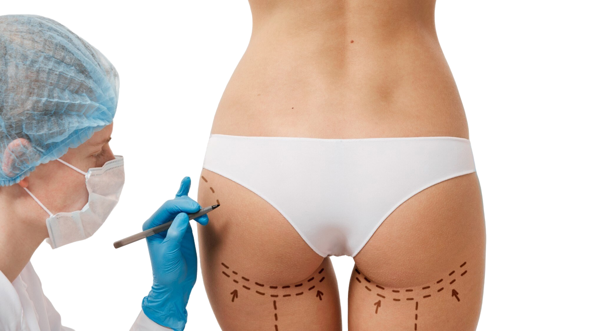 Brazilian Butt Lift (BBL)