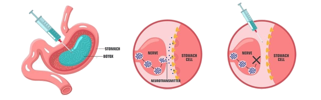Gastric Botox
