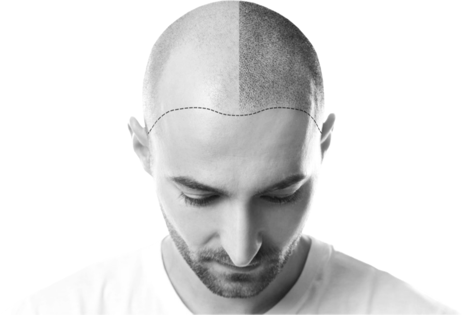 Hair Transplantation