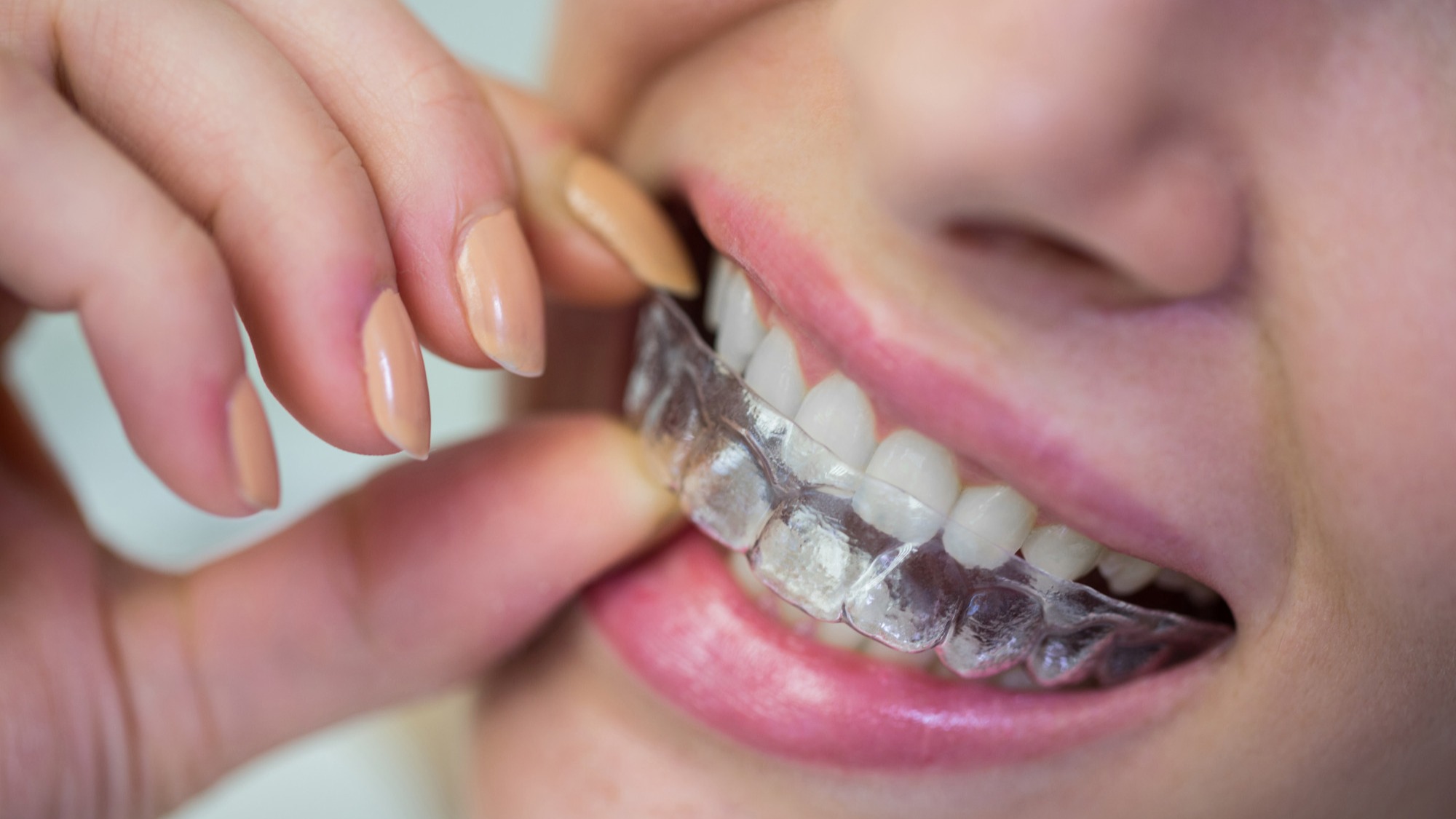 Invisalign